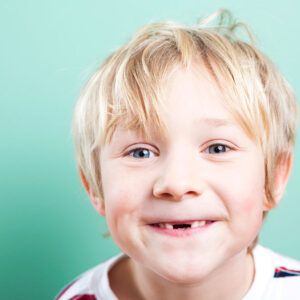پوسیدگی دندان های قدامی کودکان